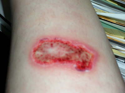Heating Pad Burn