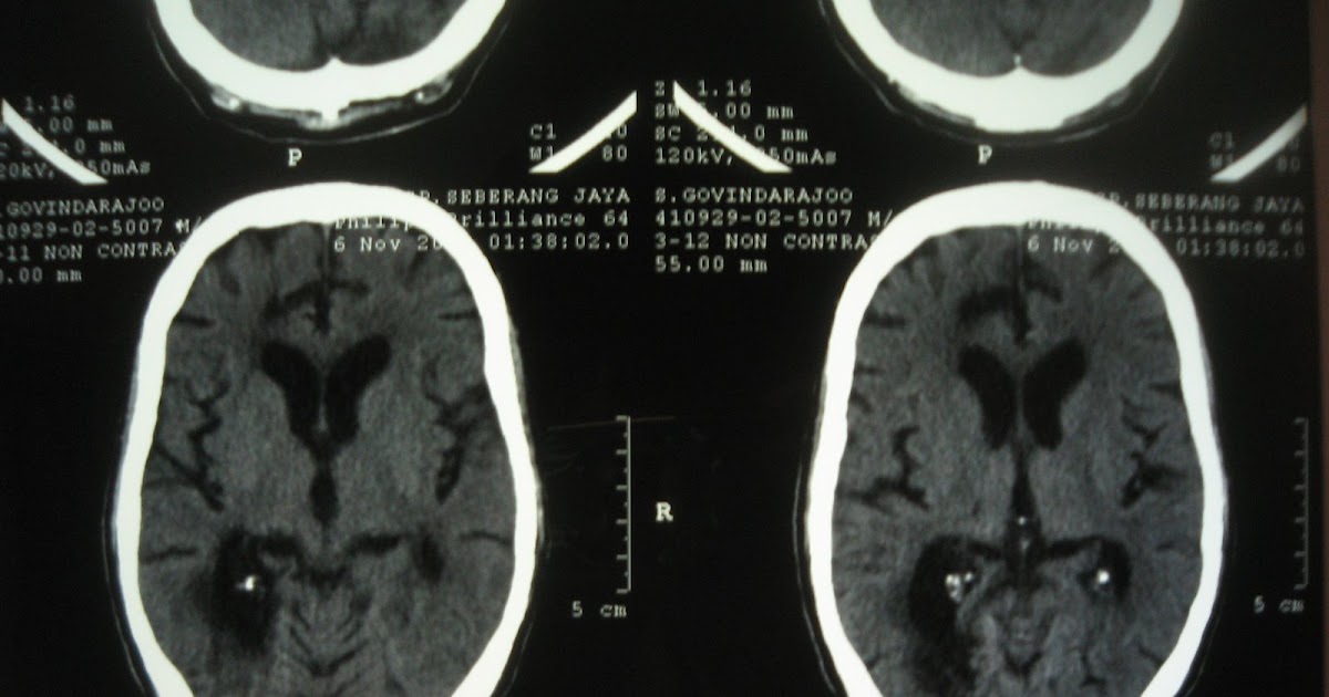 Medicine for MRCP & Medical Students: Wallenberg syndrome