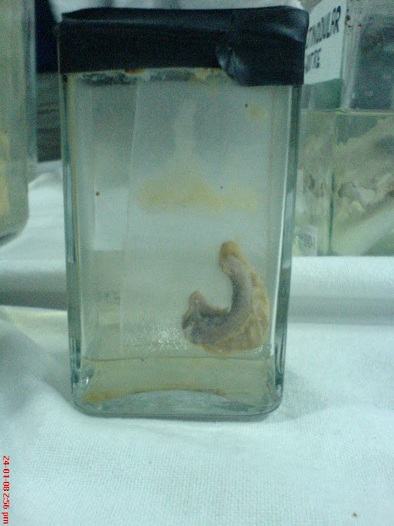 PATHOLOGICAL SPECIMENS