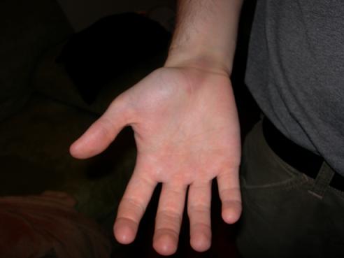 [mitchbruise2.JPG]