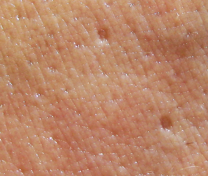 pock marks on legs pock marks on legs