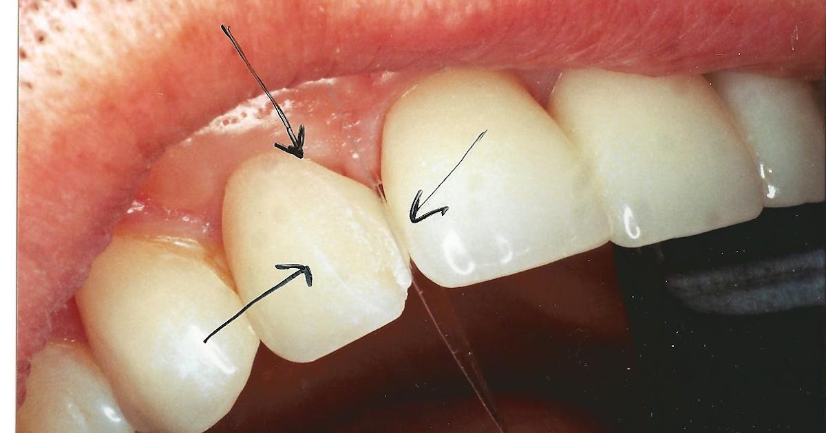 Ask Dr. Spindel Can Chipped Porcelain Veneers be Repaired?