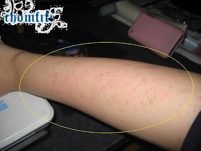 heat rash on babies pictures. heat rash on abies pictures.