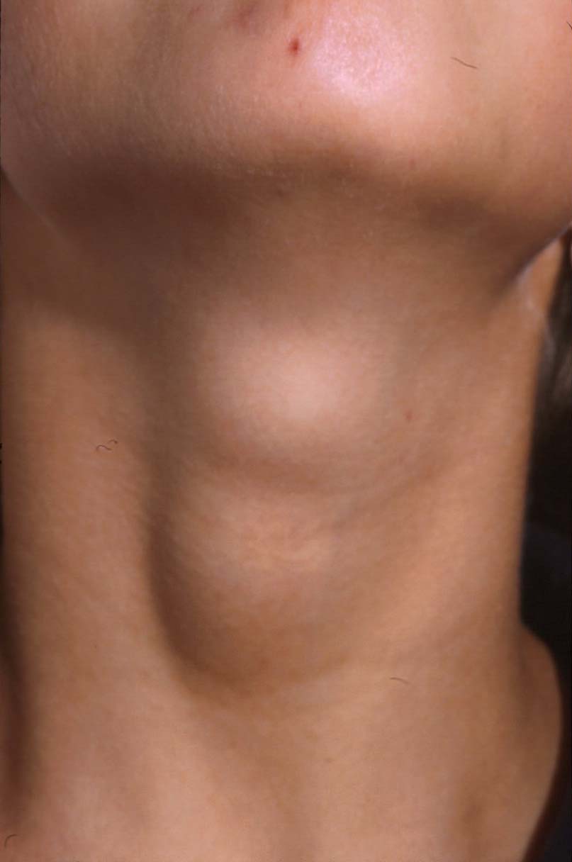 Thyroid Node