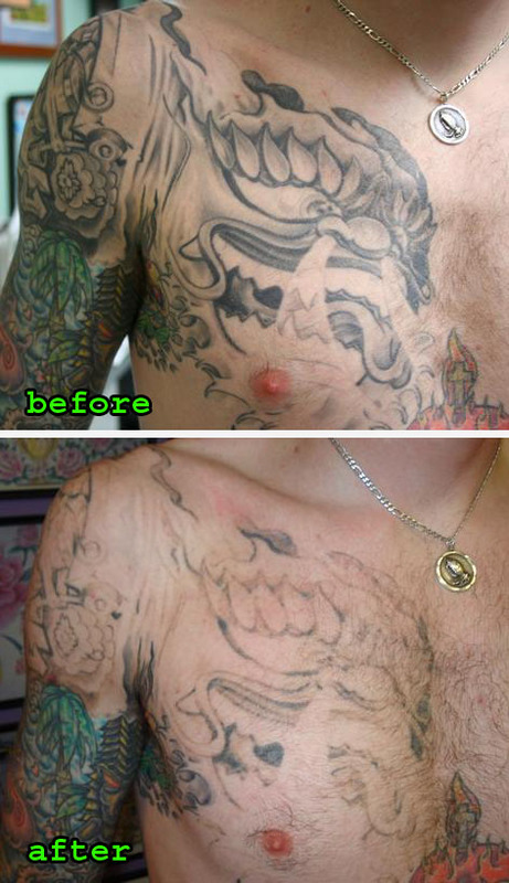 Remove Tattoos - What is the Best Method? Remove Tattoos - What is the Best Method?