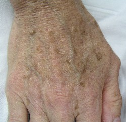 Rid of Brown Spots of skin