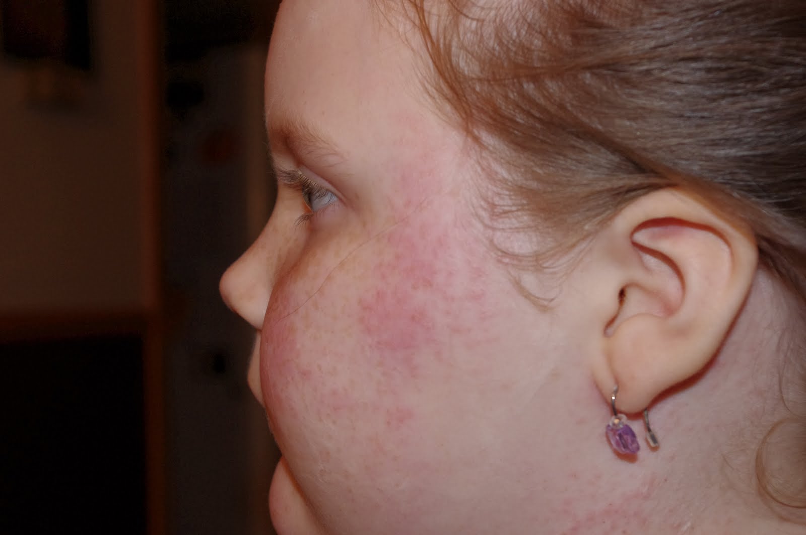 Haven Neuroblastoma Cancer and ROHHAD Syndrome Tape allergies