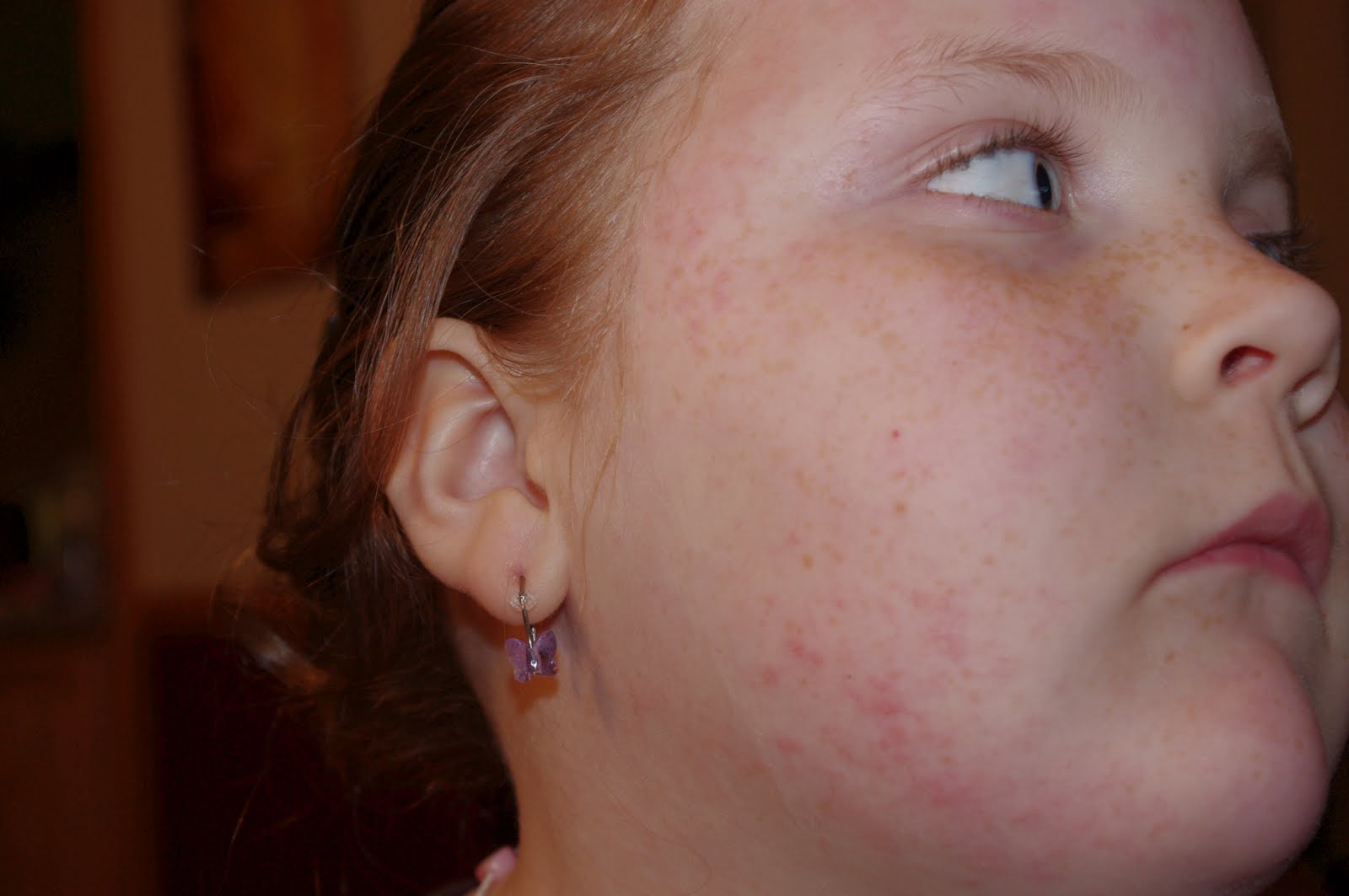 Haven Neuroblastoma Cancer and ROHHAD Syndrome Tape allergies