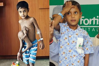 Fkk-Boys http://in-indiannews.blogspot.com/2010/06/indian-doctors-operated-on-boy-with.html