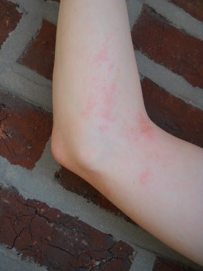 Early Poison Ivy Rash Pictures