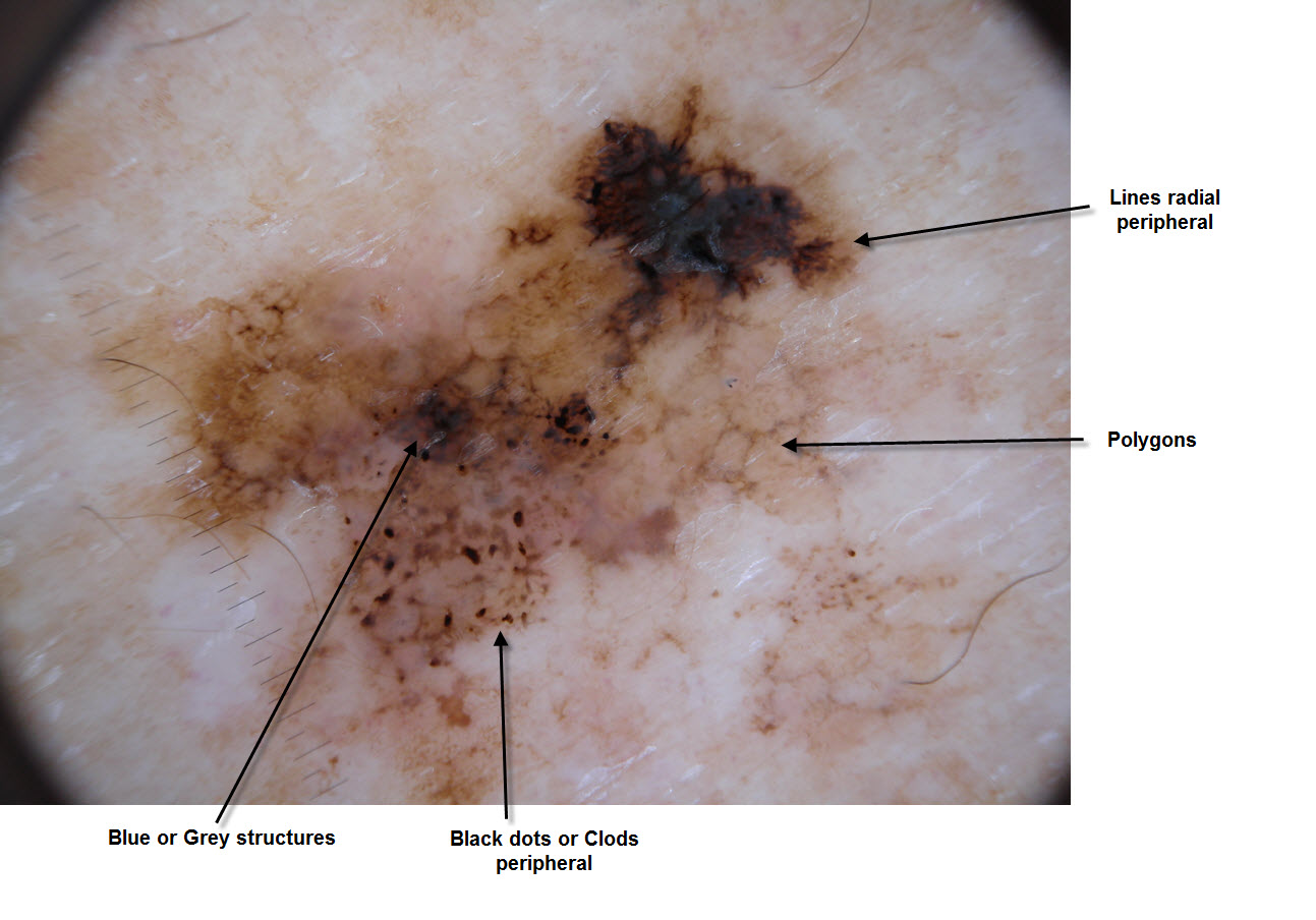 Dermoscopy Made Simple Clues to Melanoma