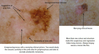 colordial nevus colordial nevus