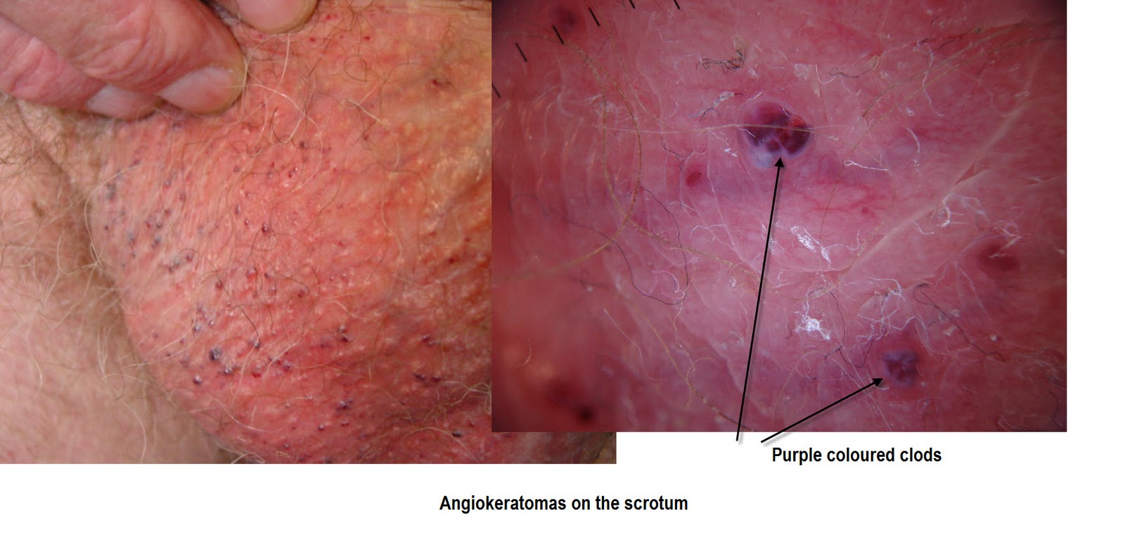 Angiokeratomas Pictures