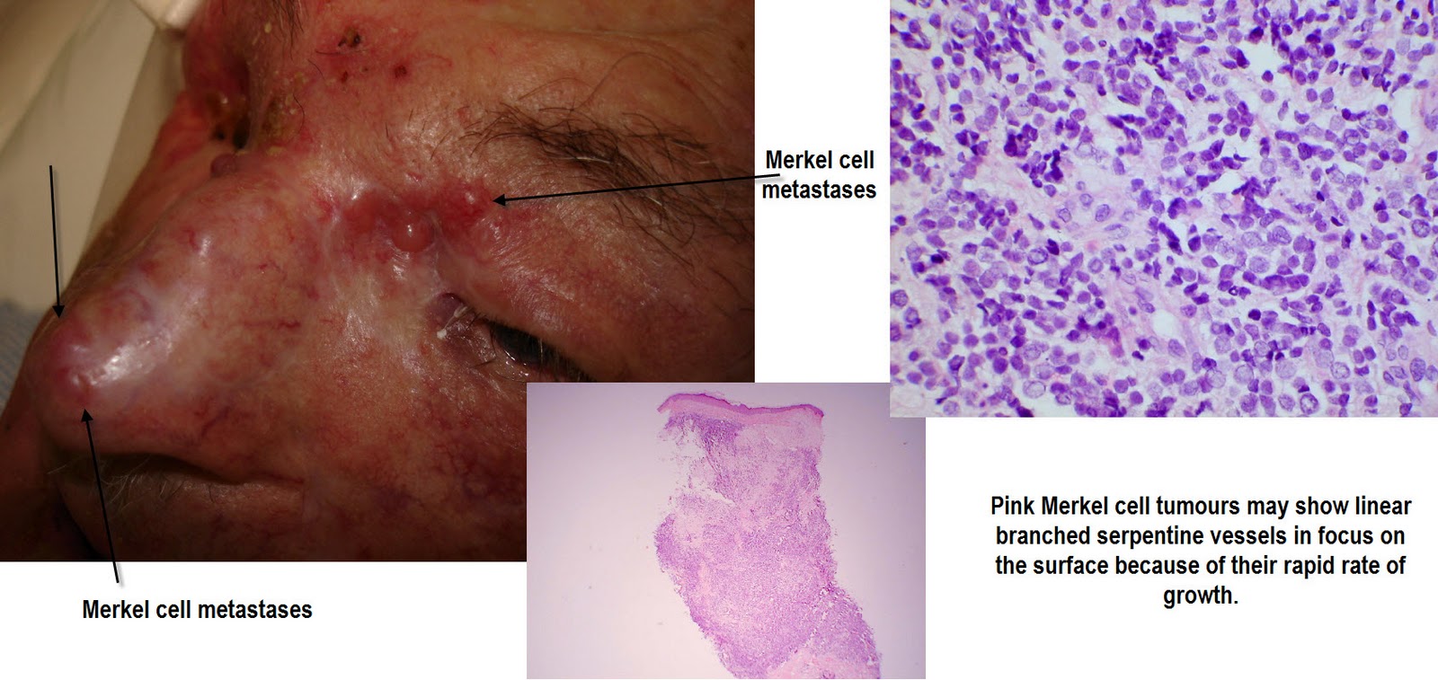 Dermoscopy Made Simple Rare And Unusual Tumours