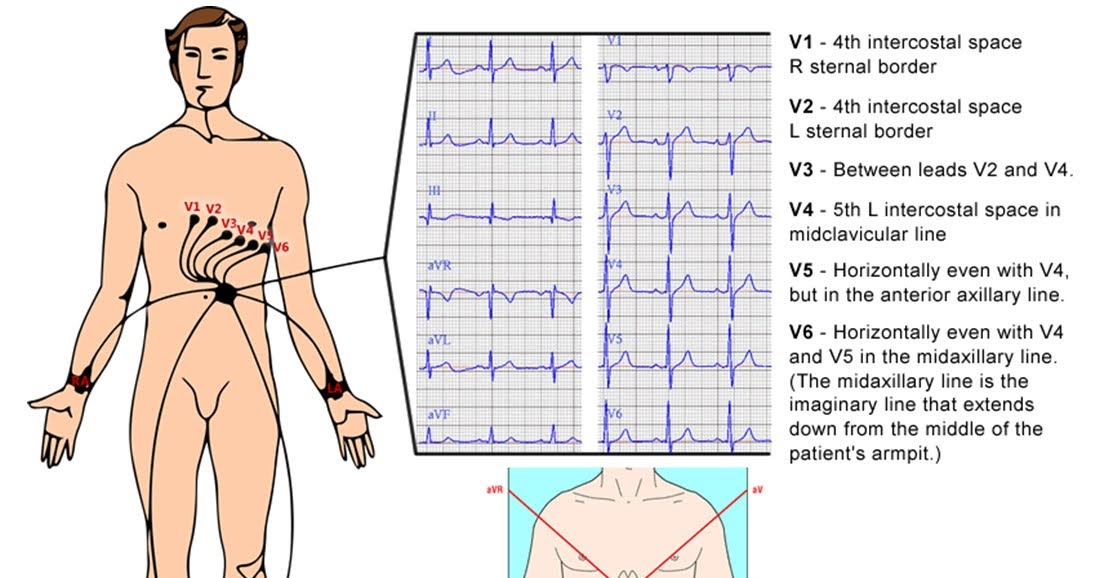 A Quick Guide to ECG IVLine