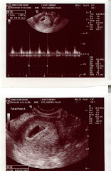 2nd Ultrasound