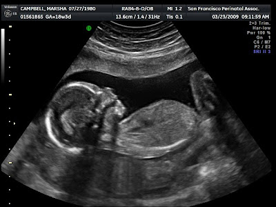 4 weeks days ultrasound 3 What to