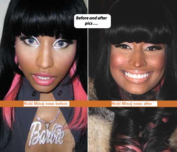 nicki minaj before and after surgery photos