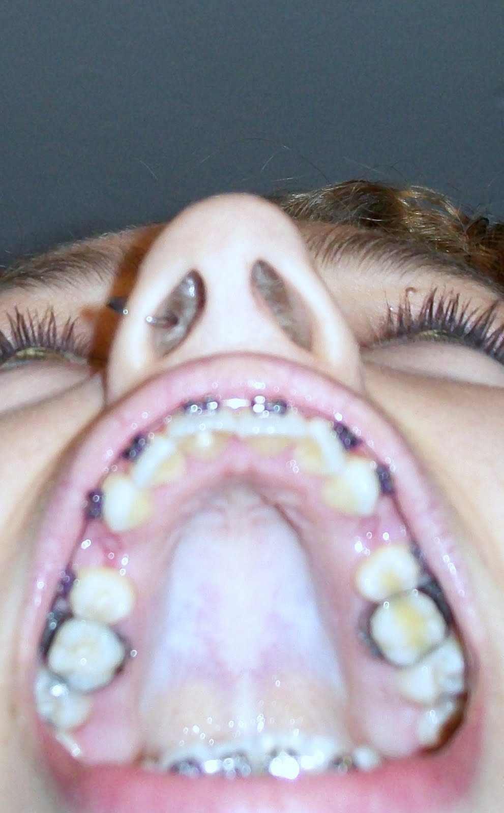 Braces at twenty My First Braces Tightening