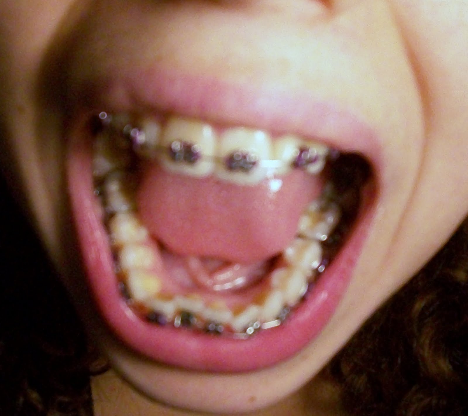 Braces at twenty My First Braces Tightening