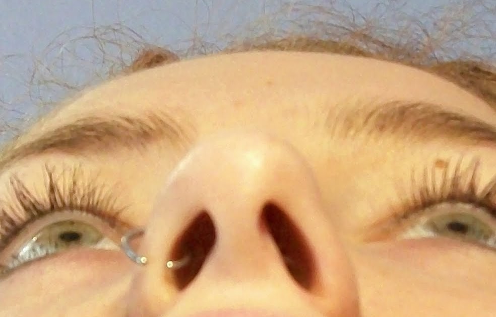 Braces at twenty Spacer and Extraction pictures