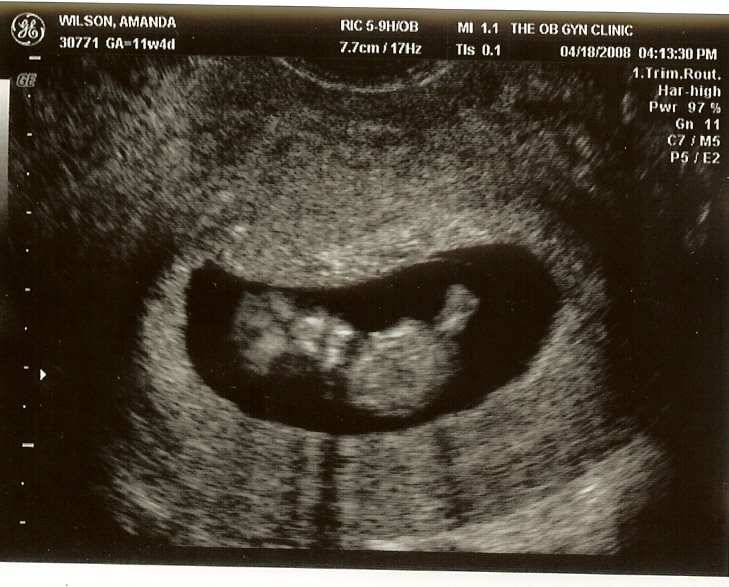 [Sonogram+11+weeks+6.jpg]