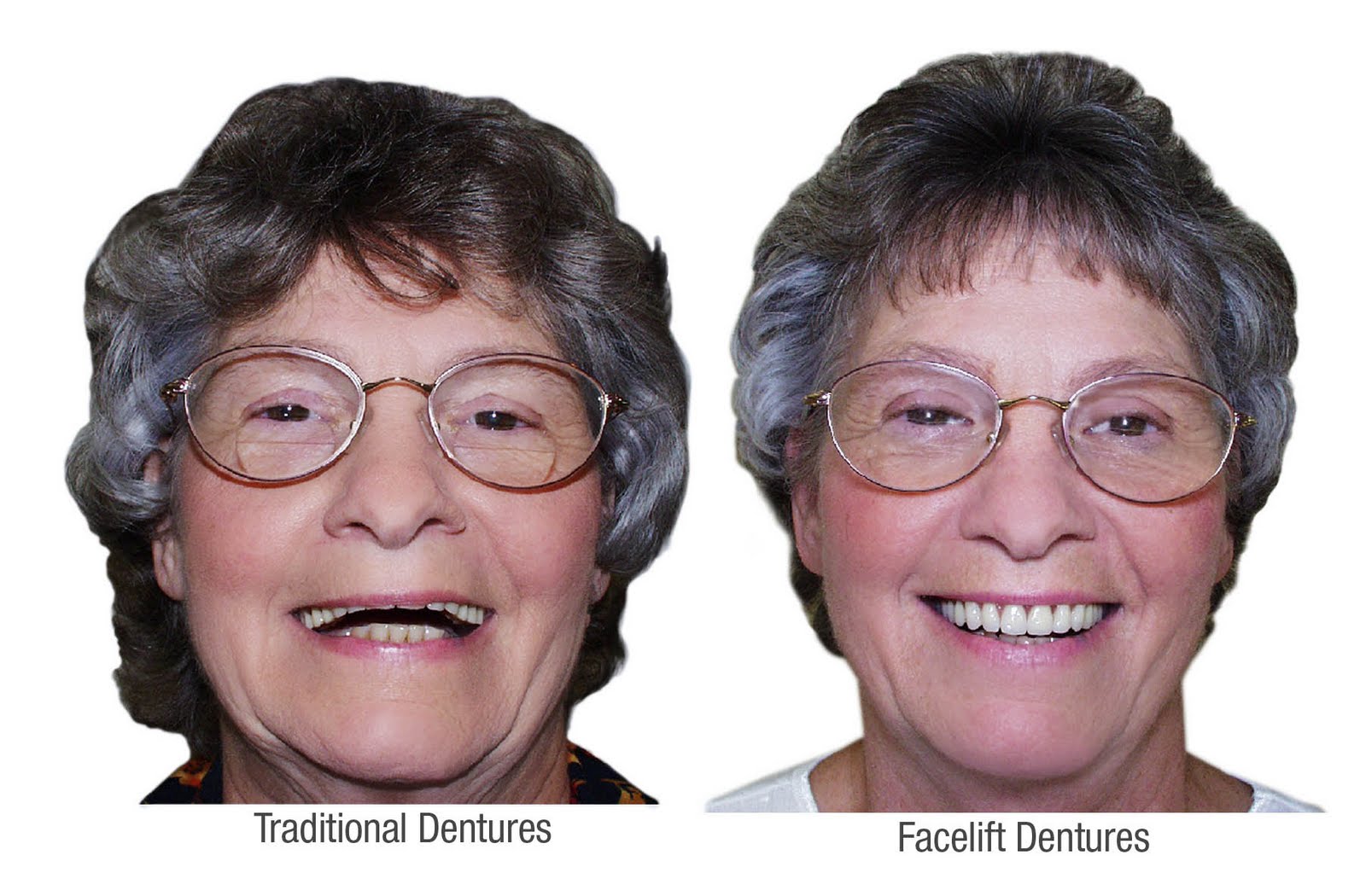 Dental Care Dentures