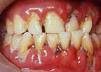 periodontitis