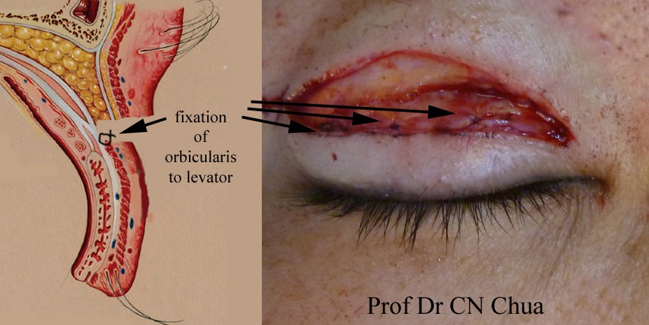 Eyelid Surgery by Prof Dr CN CHUA 蔡鐘能: Turning Single Eyelid into