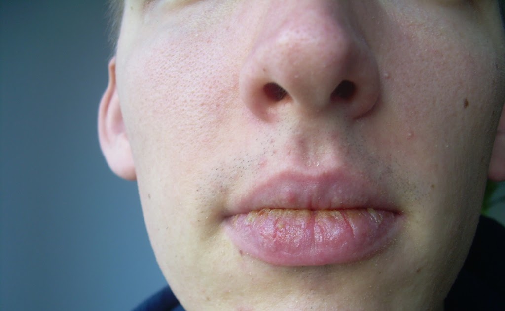 Exfoliative Cheilitis Blog Back to Lip Balm Day 12