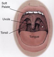 Easiest Way To Get Rid Of Tonsil Stones : Sleep Apnea Revealed!