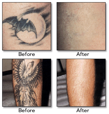 Here at Gardens Cosmetic Center we offer a new tattoo removal method in