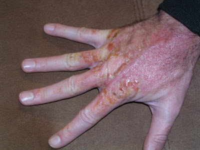 small poison oak rash. poison sumac rashes. pictures