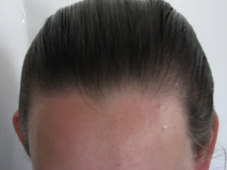 My Receding Hairline Experience Hair Loss Regrowth Photos