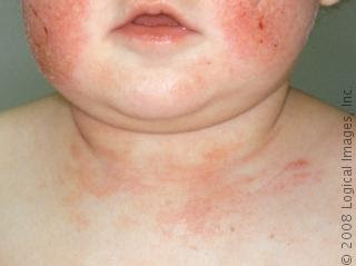 Resultado de imagem para dermatite atópica bebe