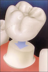 Esquema de Corona Dental de Porcelana