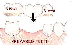 Puente Dental de Porcelana