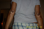 Common pigment loss on elbows