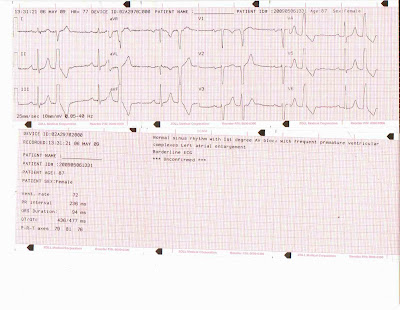 Bigeminy Ekg