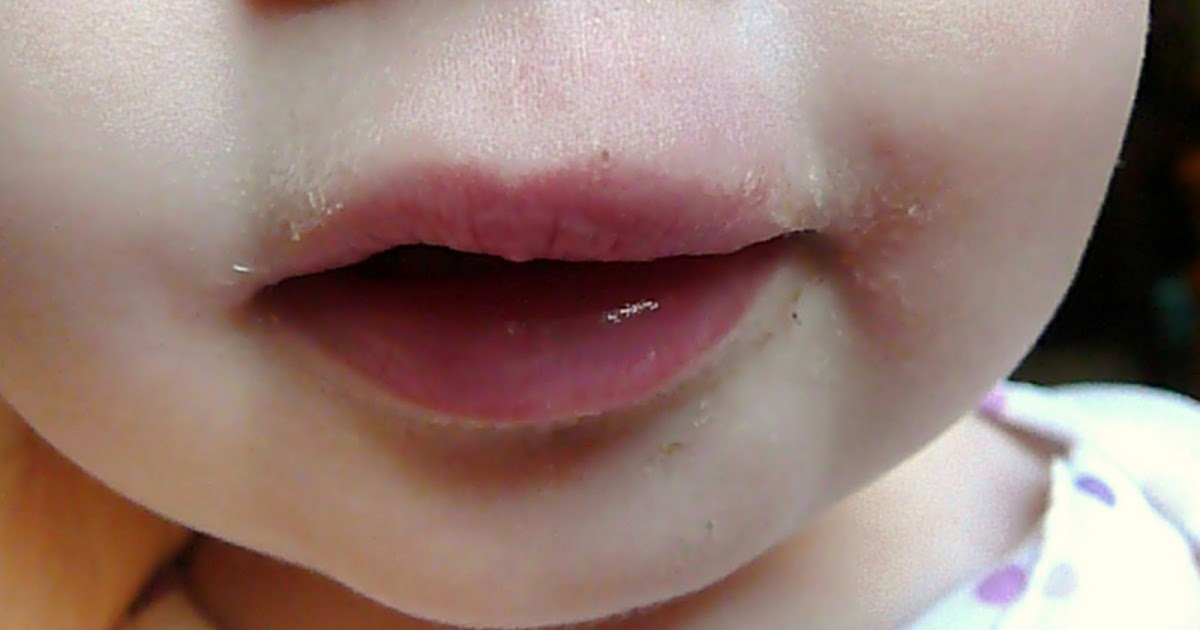 The Inspired Spider A Busted Lip and Blood Make an Upset Toddler & Mommy