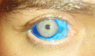Blue tattoo on the back of the eye cornea blue