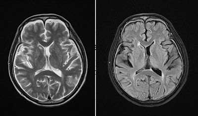 Cerebral Hypotension