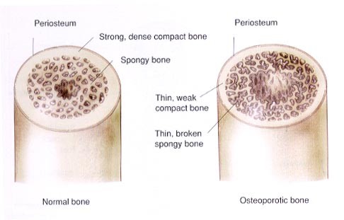 bone thinning