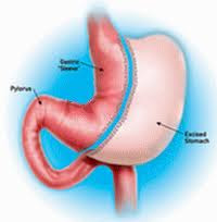 Picture of Gastric Sleeve