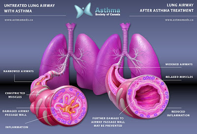 Get Asthma From Hotel Rooms Get Asthma From Hotel Rooms