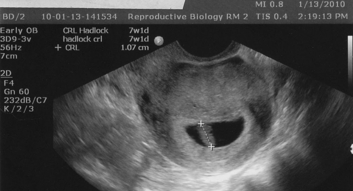 Diary of a Stork Stalker Enlarged Yolk Sac