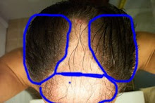 Pre repair hair transplant pictures