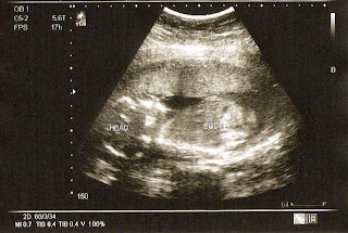 Our baby at 20 weeks