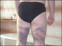 Iurie Craciuneac's beaten legs
