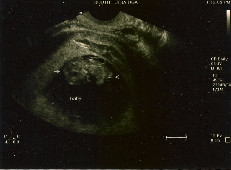 Editor Joy: Ultrasound Day! 10 Weeks Pregnant
